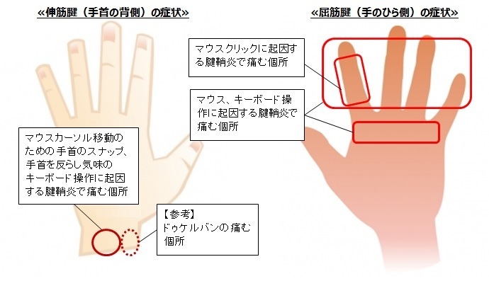 自分の腱鞘炎の正体 明日天気になーれれれ